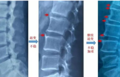 常德宝岛医院疼痛科科普“骨刺”的治疗